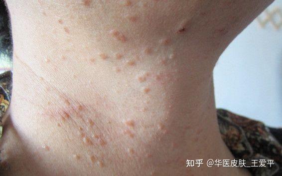 为什么扁平疣在夏天会加重?教你如何护理扁平疣 - 知乎