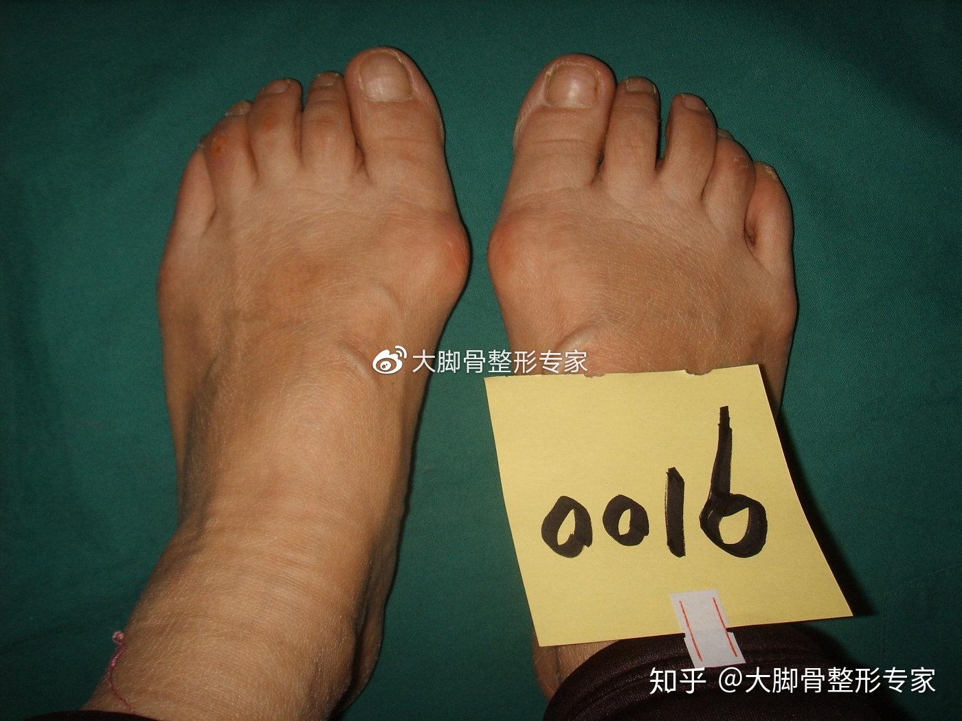 北京丰台广济医院科普：大脚骨会对身体有什么影响? - 知乎