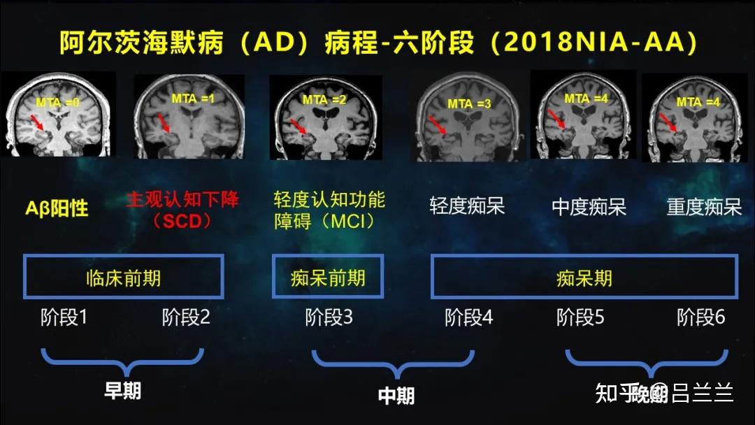 拿癌症打比喻大家就好理解了,临床前期阶段1和2,好比癌症早期,3,4