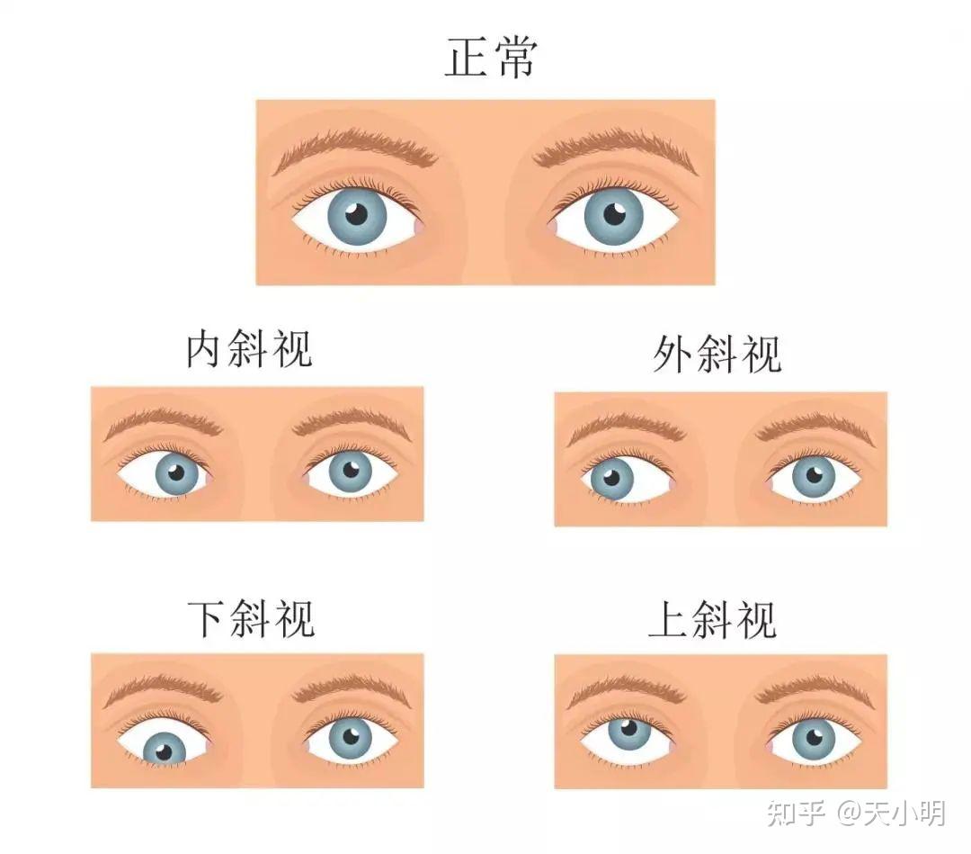 视觉训练是什么?有什么用? - 知乎