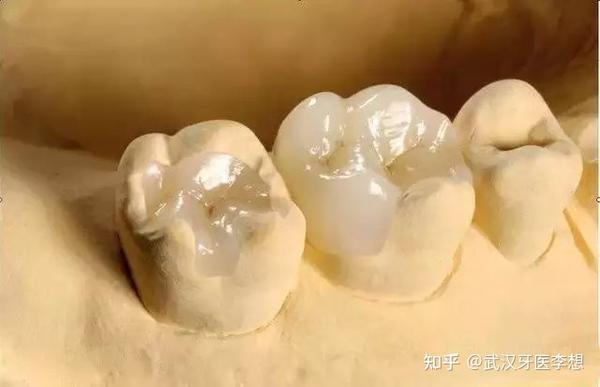 常用的三种补牙材料对比 - 知乎