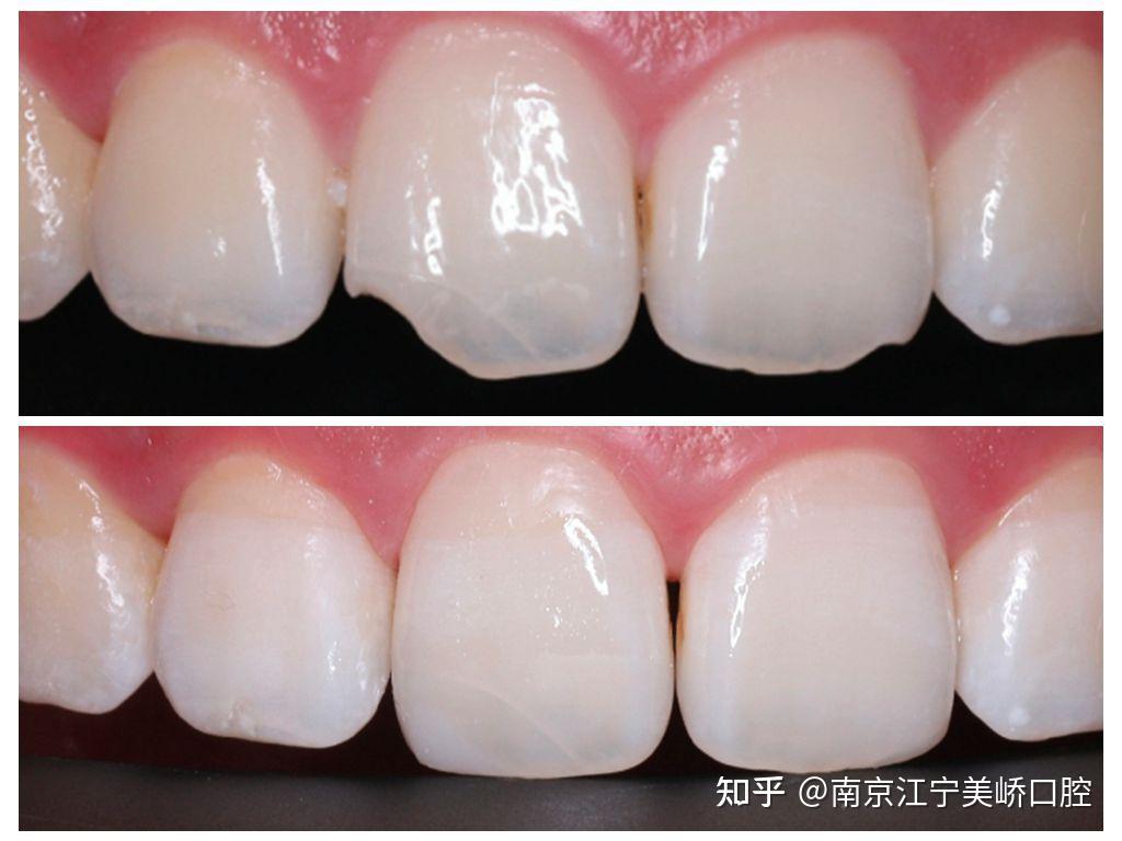 高国祥：前牙树脂局部贴面-北京瑞皓医疗科技有限公司