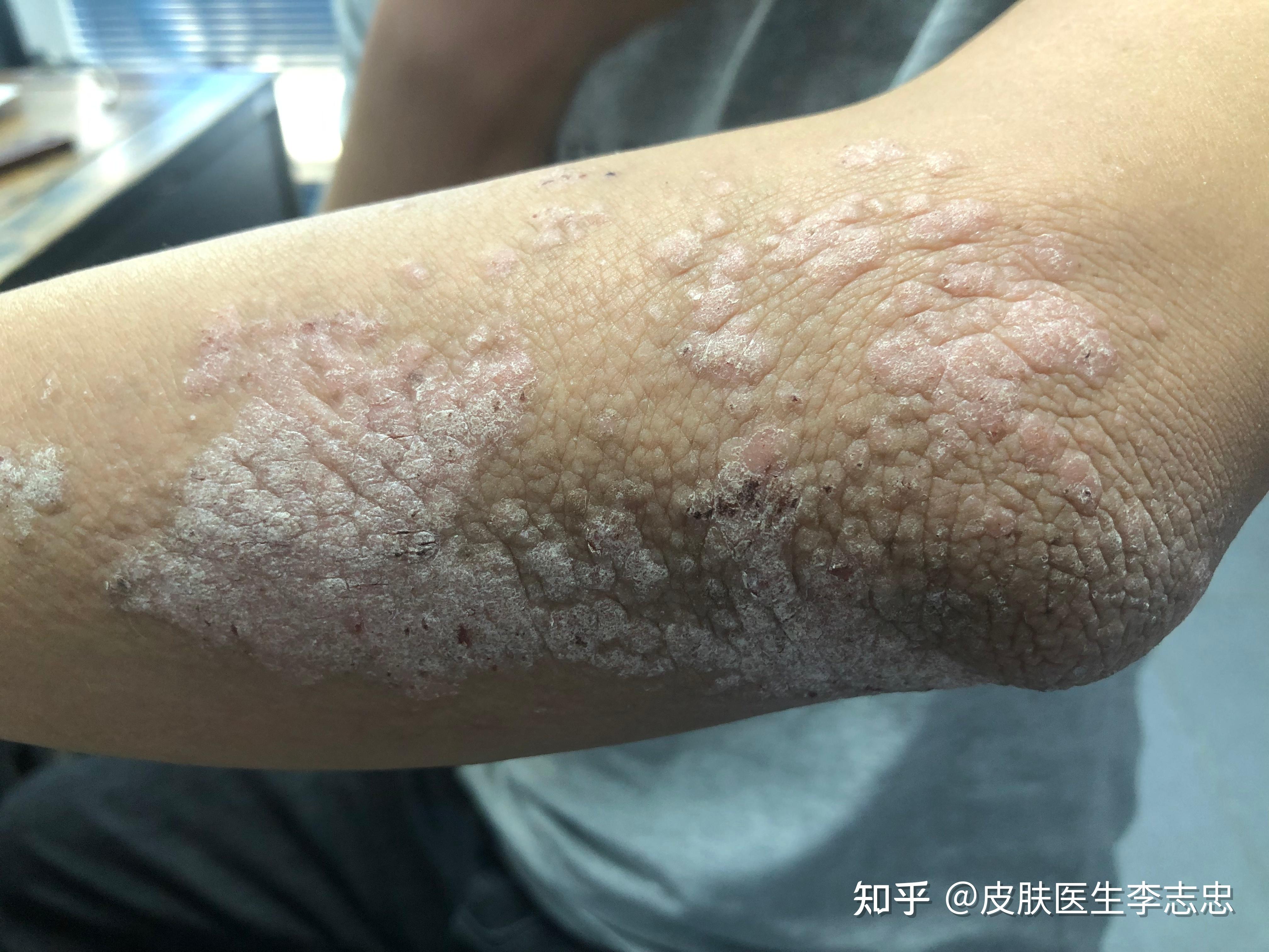皮肤科最常用、最好用的两个妙方——当归饮子和消风散 - 知乎