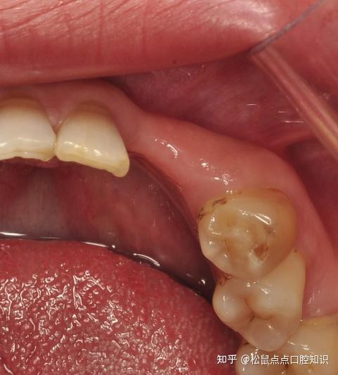 定位,预备取骨区预备滋养孔,取下骨块自体骨块移植