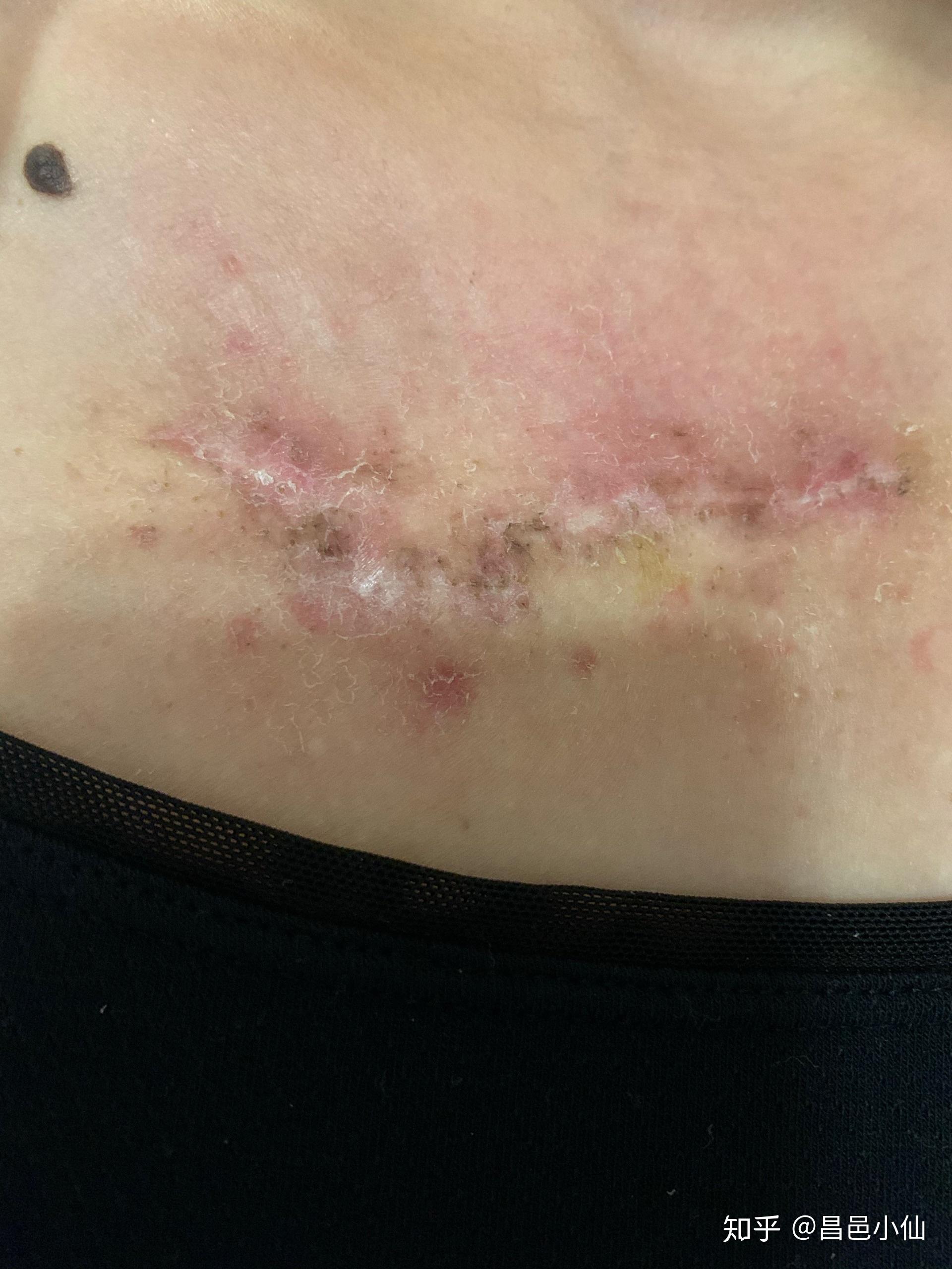 纤维瘤手术后疤痕图片