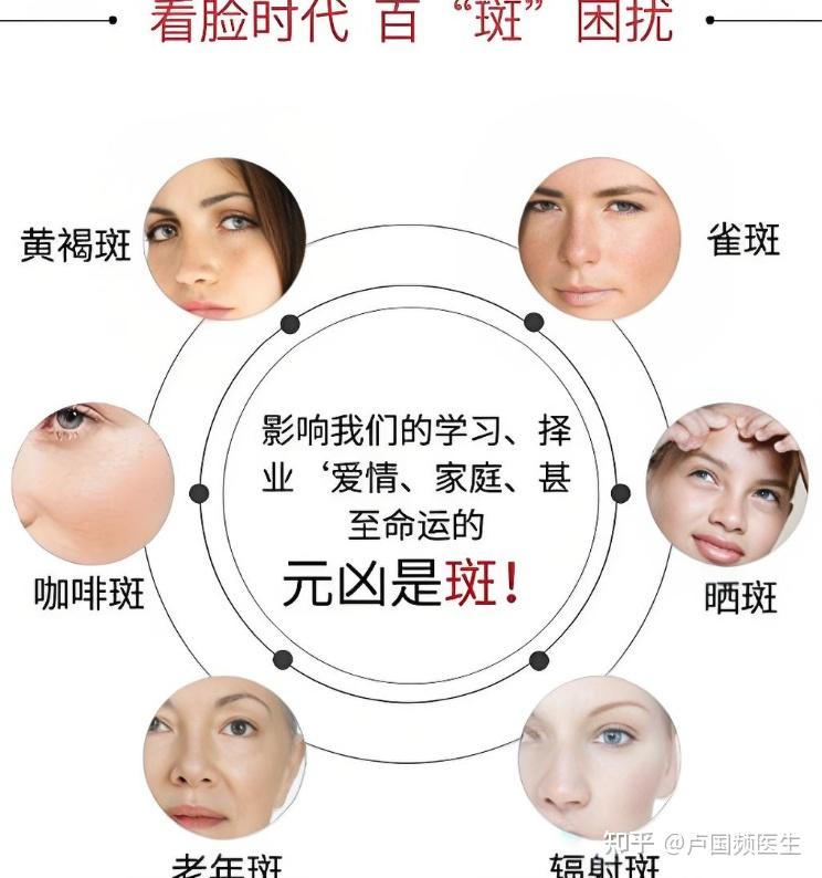 黄褐斑分型分类治疗全解:诊断与鉴别,适配药物与浓度,远离病因 - 知乎