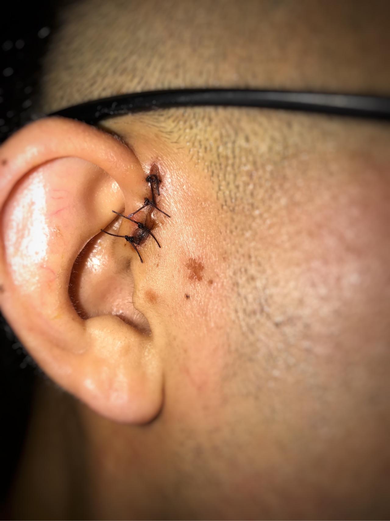 患有先天性耳前瘘管是一种怎样的体验? - 知乎