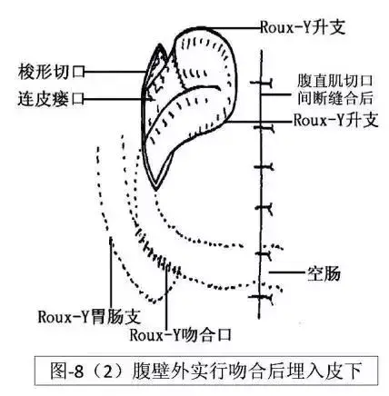 胃缝合方法图解图片