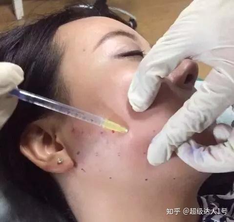 溶脂针是瘦脸减肥还是毁容? 原理,副作用,效果