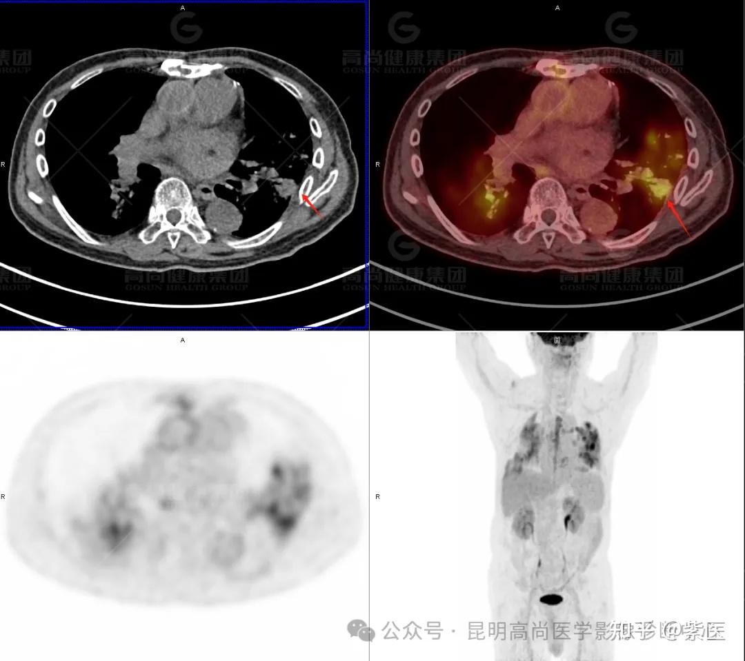 PET/CT诊断肺炎型肺癌 - 知乎