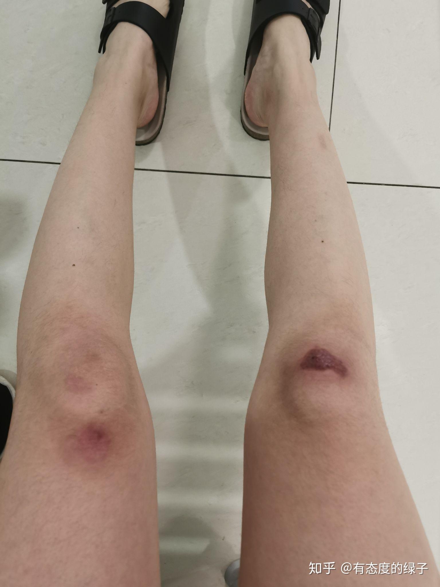 膝盖瘢痕疙瘩 - 知乎