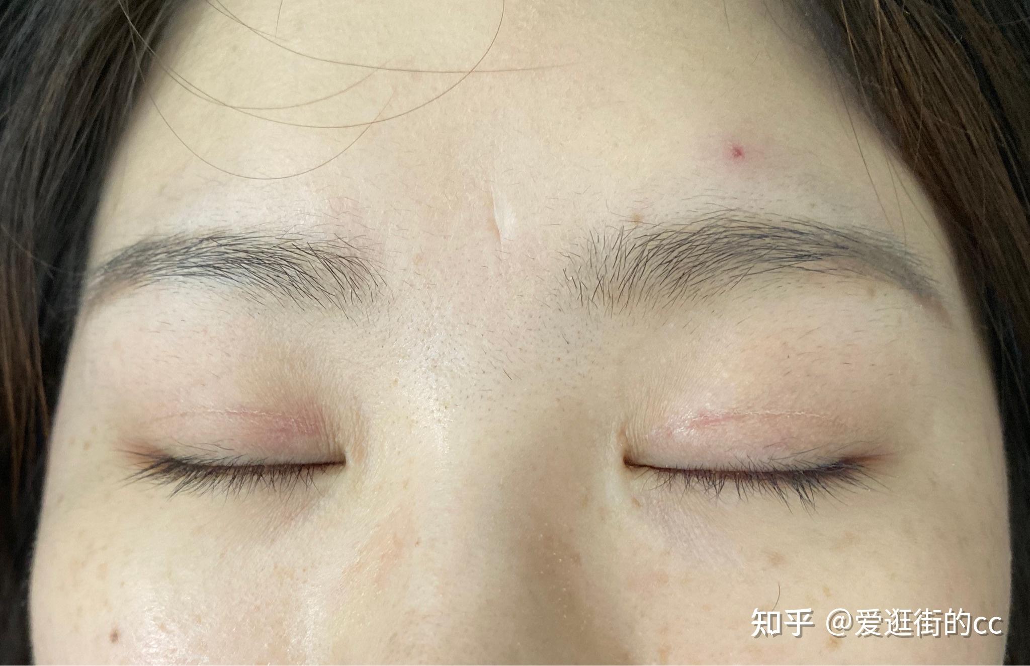 双眼皮全切开眼角恢复过程记录