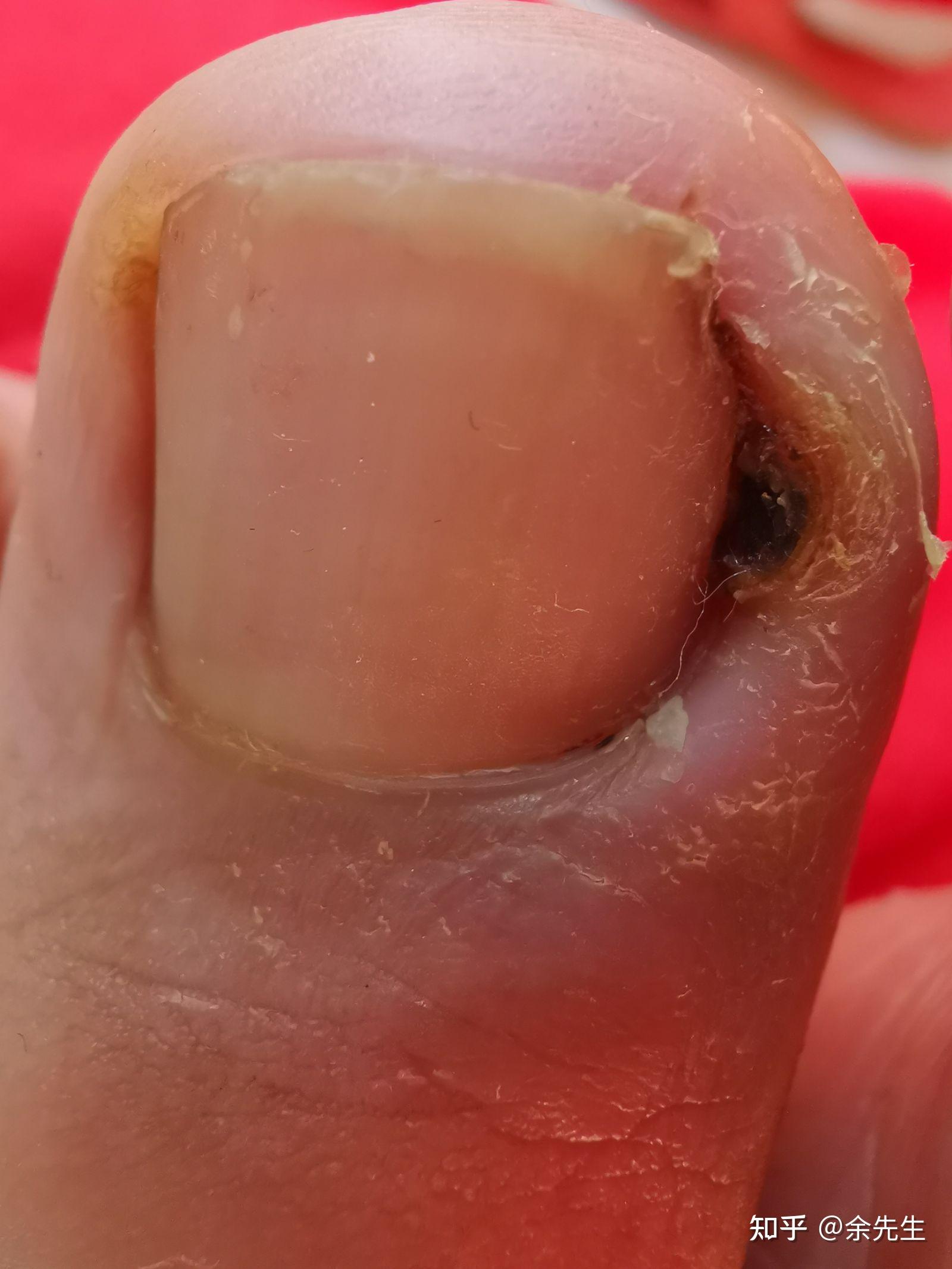 如果甲沟炎已经开始化脓了自己应该怎么处理