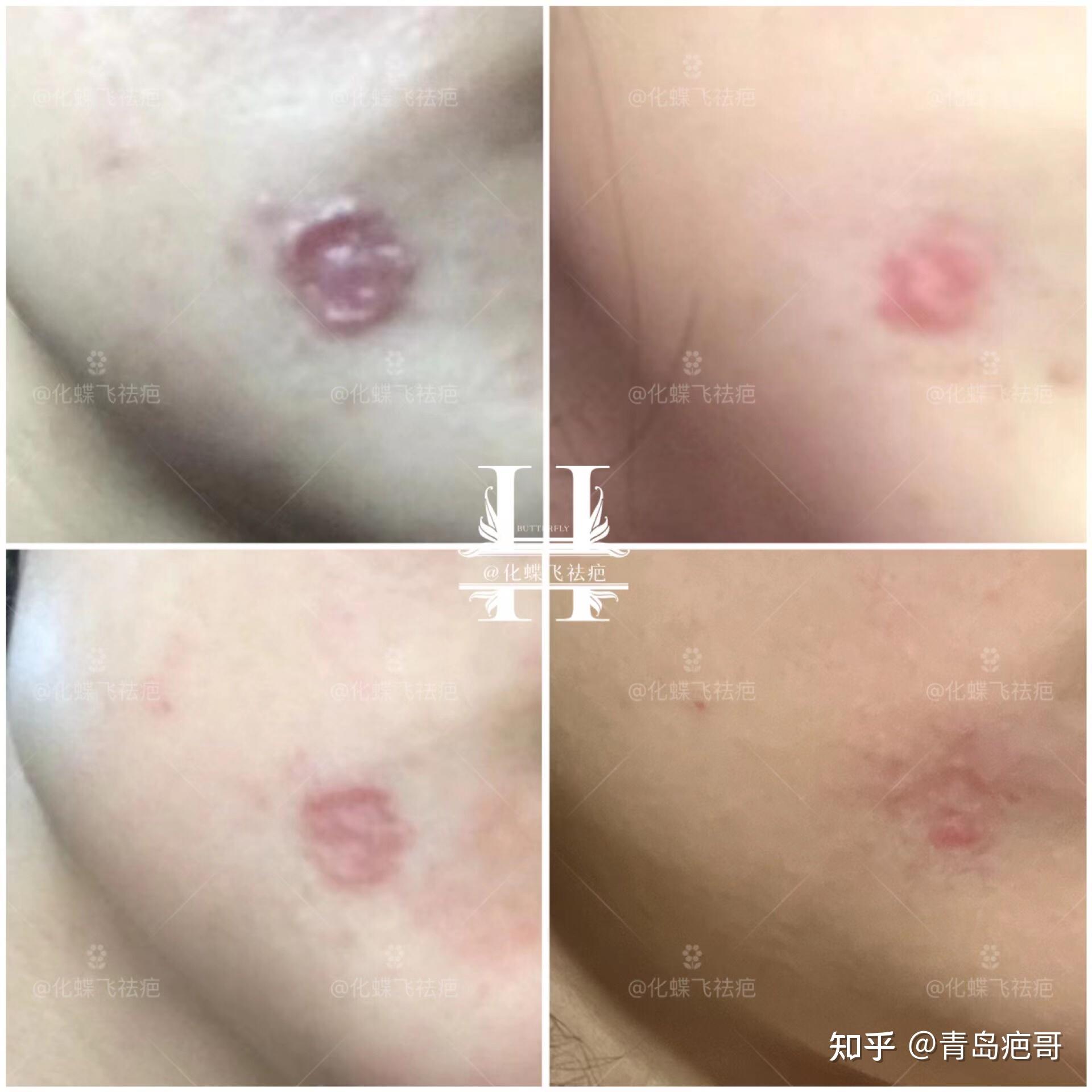 脸上点痣增生疤痕修复