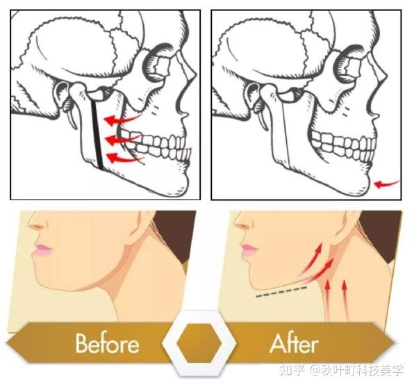 明星都去做的——日式小颜术