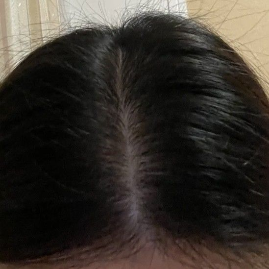 女生宽发缝、高发际线，用育发液可以恢复正常吗 - 知乎