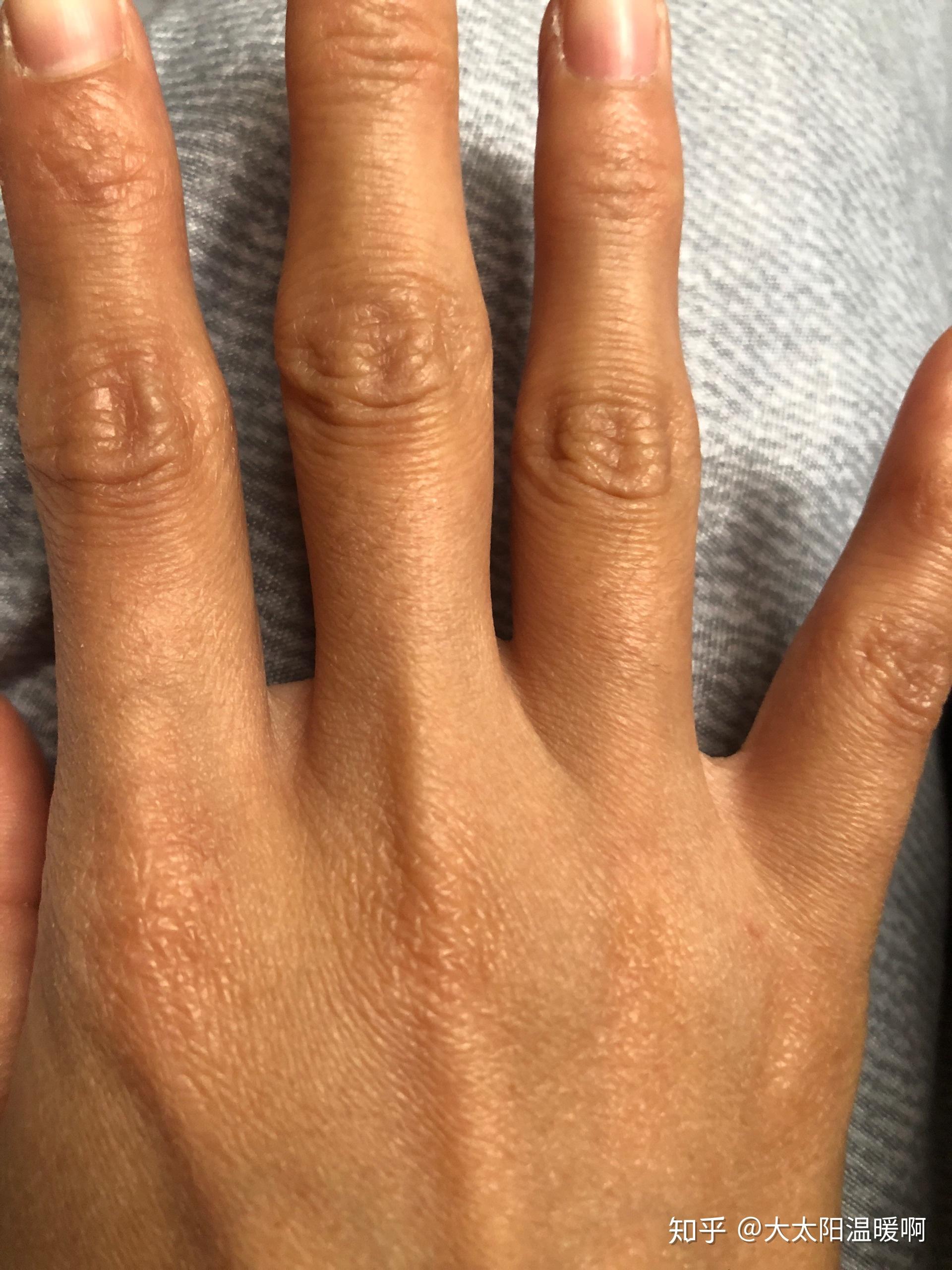经常掰指节手指关节变粗且关节处皮肤变黑怎么处理可以还原吗