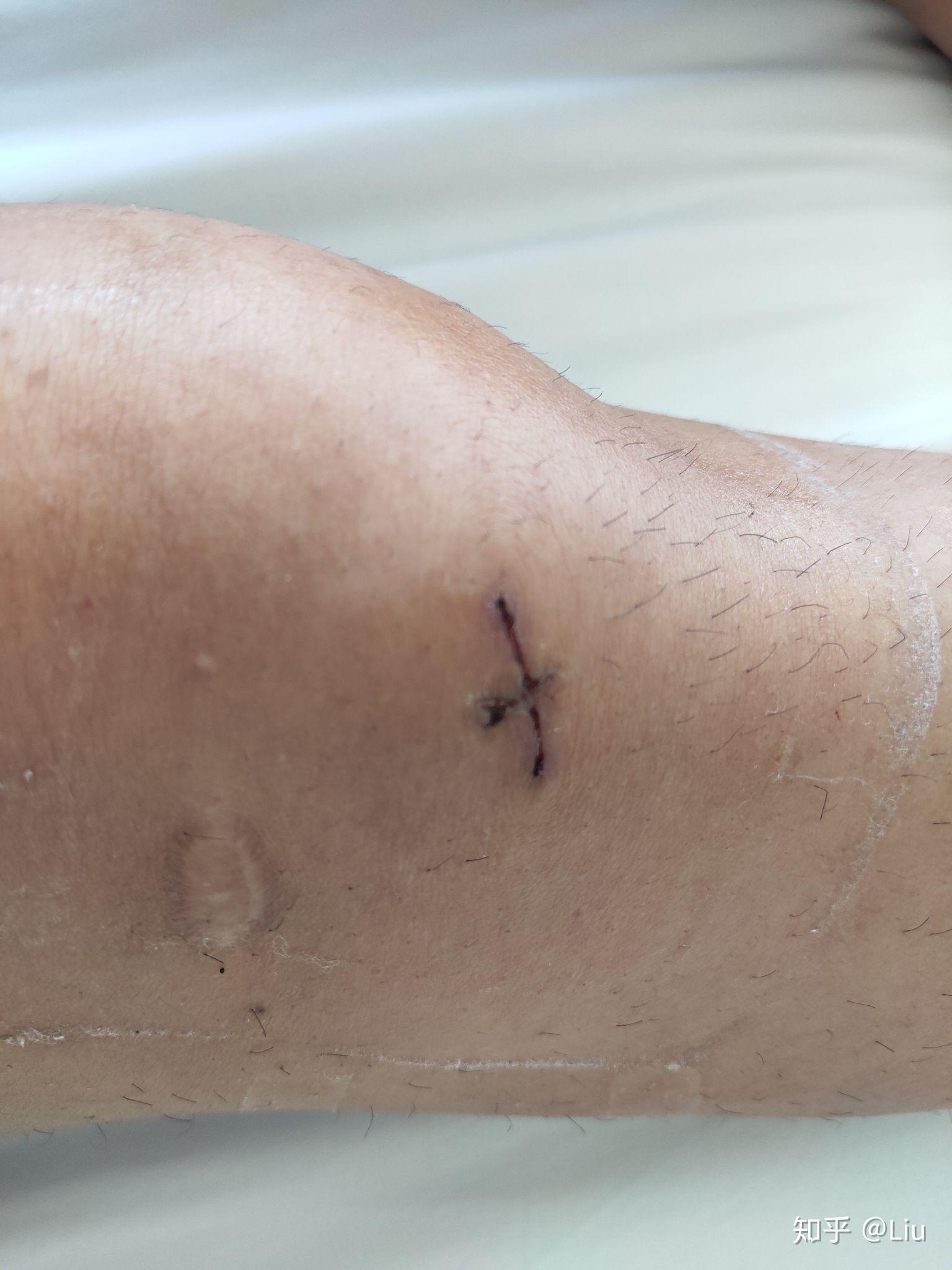 半月板手术后伤口图片图片