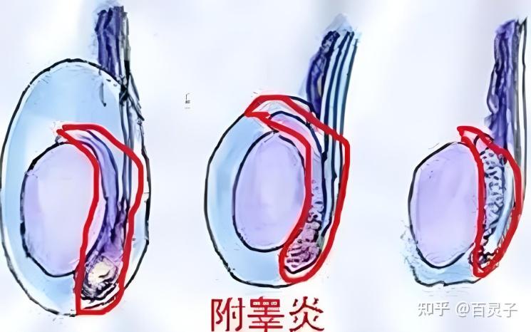 结扎导致附睾炎怎么治疗 - 知乎