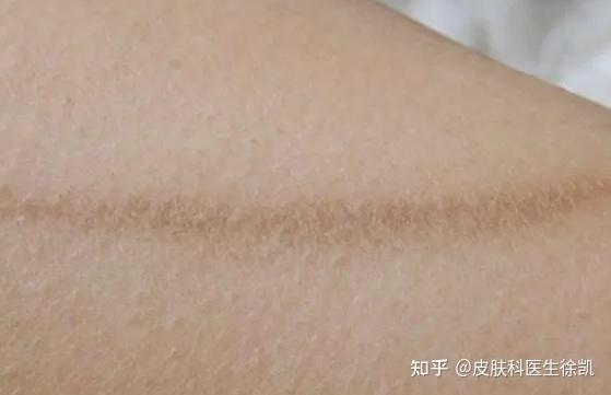 疤痕多久可以恢复到正常颜色?疤痕什么时候能恢复正常肤色? - 知乎