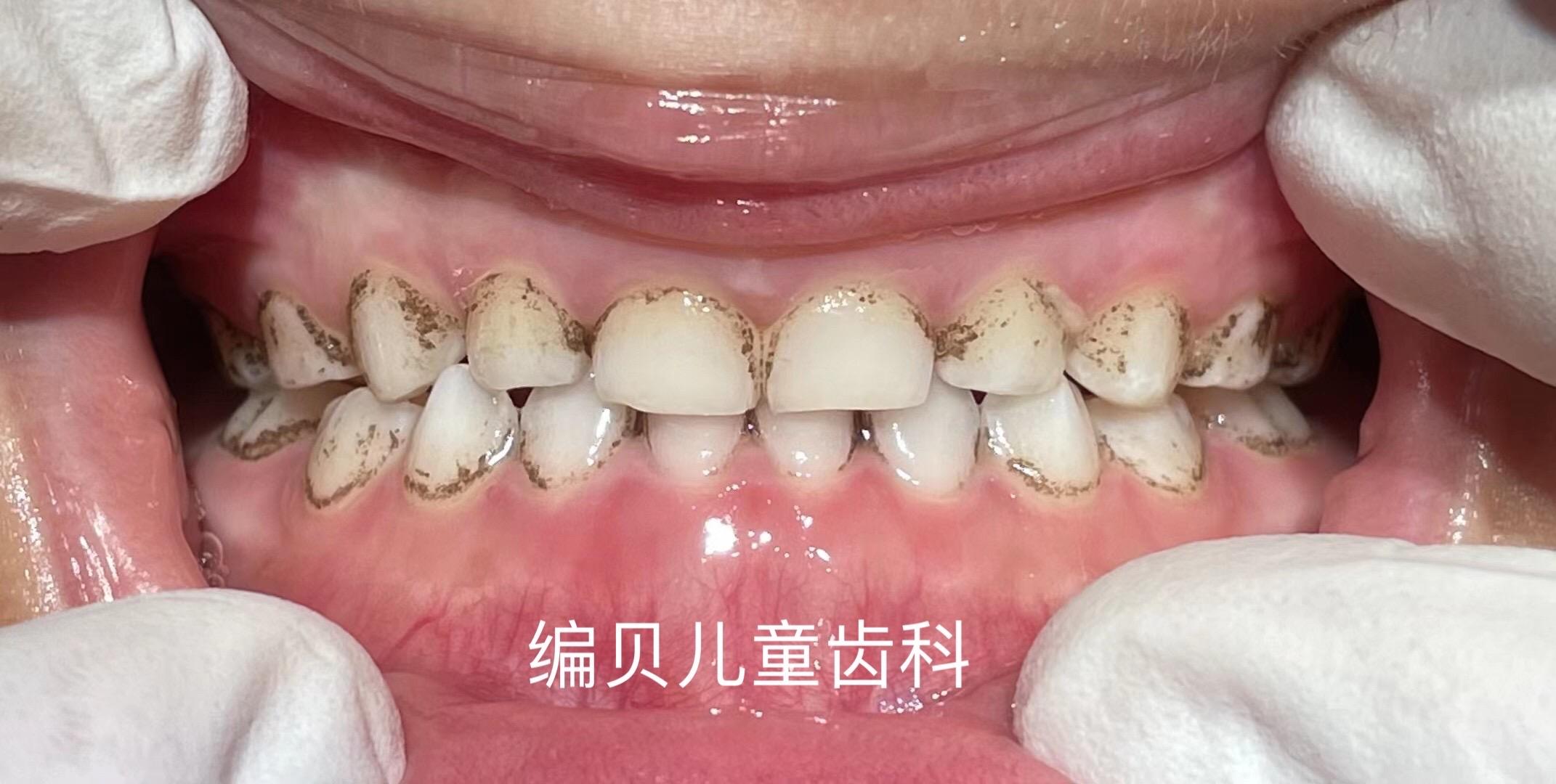 义齿修复最简单方法（牙列缺损的可摘局部义齿修复：传统可摘局部义齿修复概述讲座01） | 说明书网