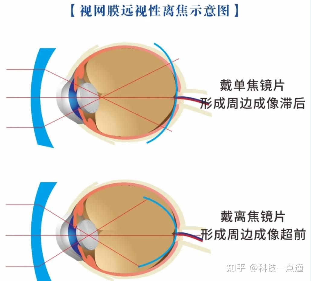 如何选购合适的离焦镜?