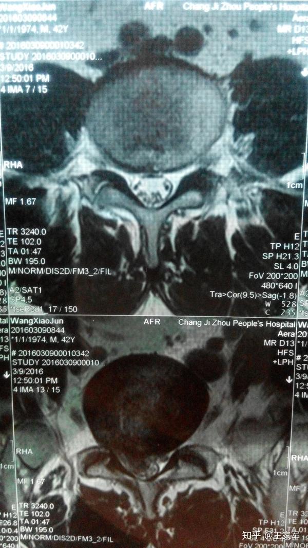 腰間盤脫出患者的幾年來的核磁共振片子