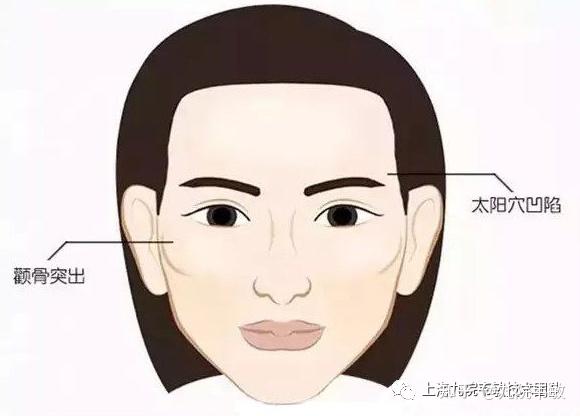 九院韦敏 | 颧弓颧骨内推后,会容易骨折吗? - 知乎