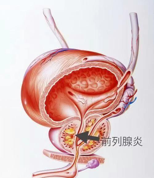 什么叫前列腺炎图片图片