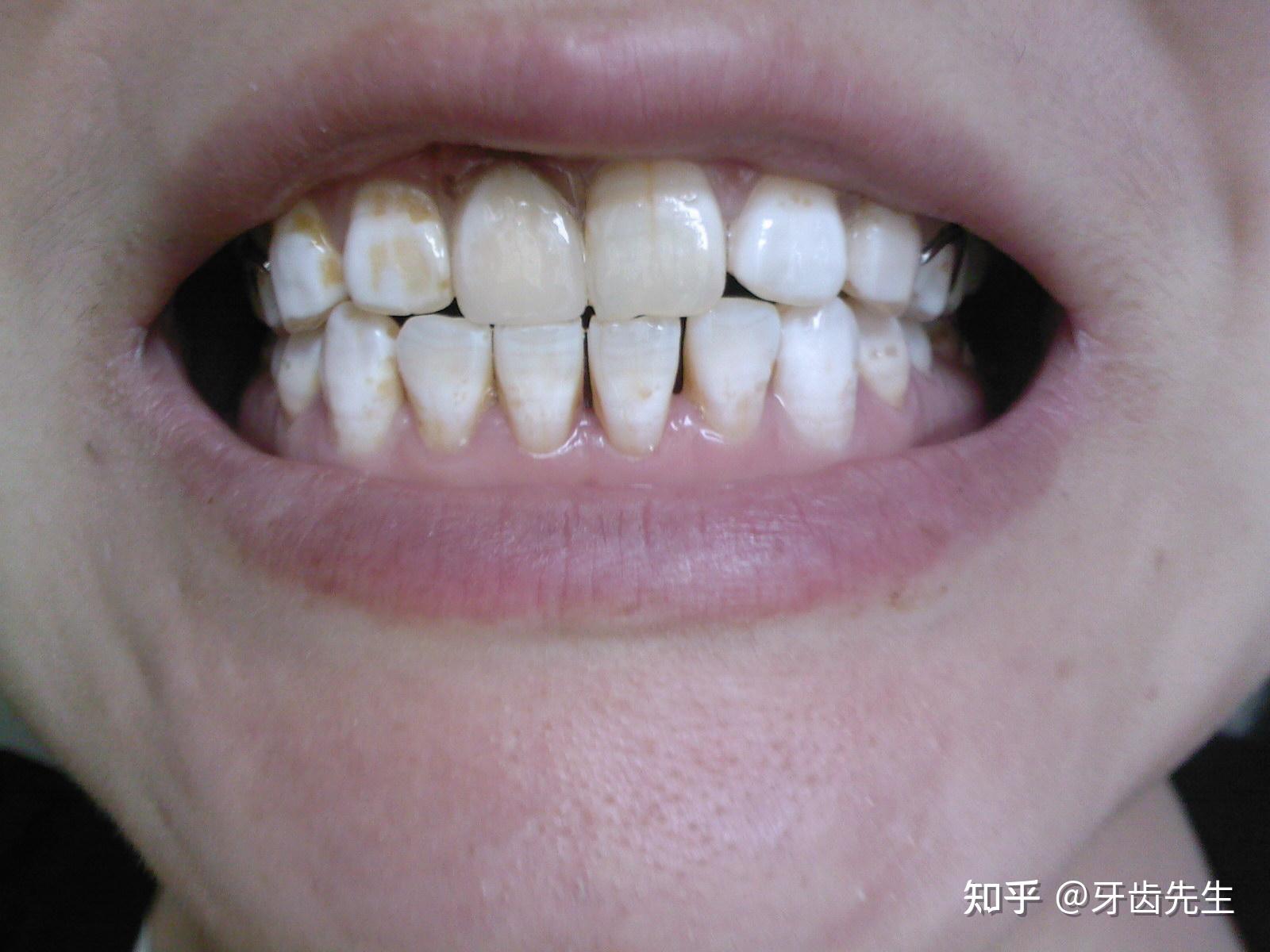病例五：烤瓷冠修复氟斑牙 - 好大夫在线