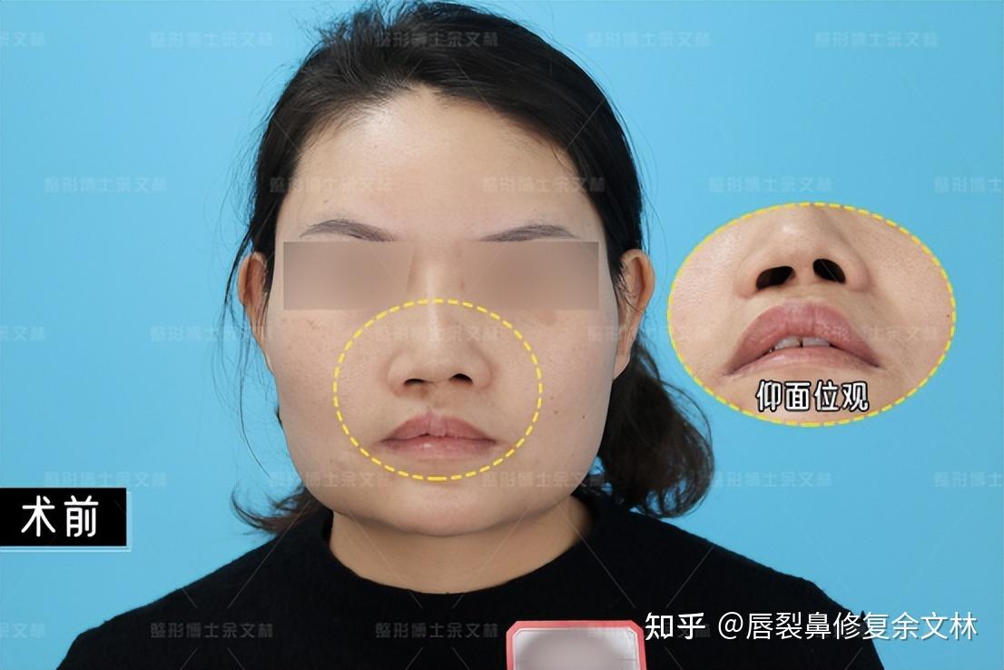 单侧唇裂修复 + 鼻整形:如何在功能重建基础上实现自然美学? - 知乎