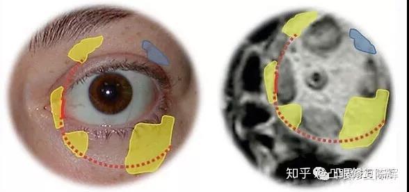 如何判断自己的甲状腺相关眼病(甲亢突眼)是否已经稳定? - 知乎