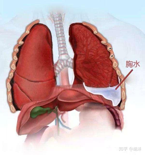肺积水 是怎么回事 为什么肺出水要检查心 肝 肾 知乎