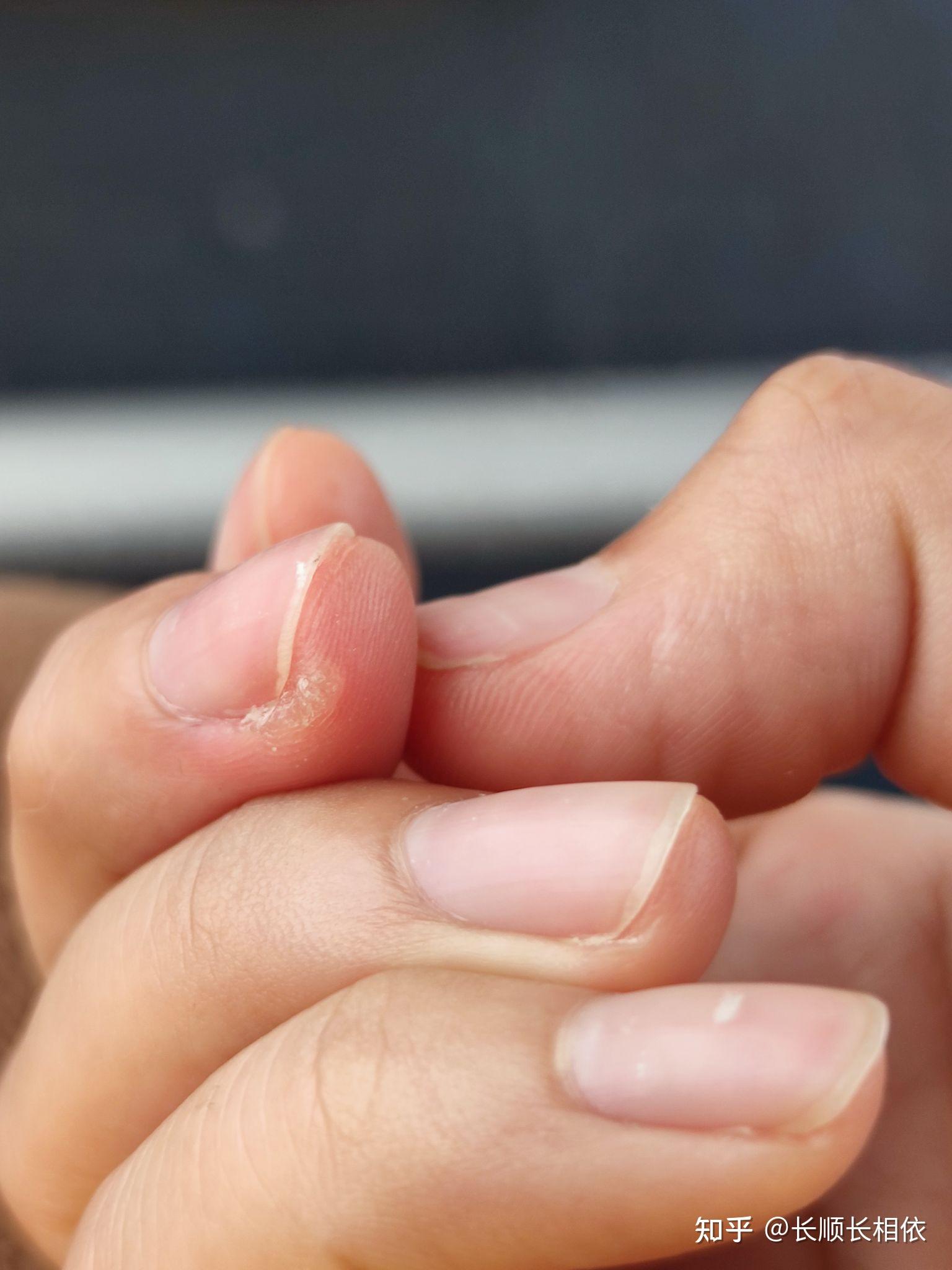 激光去除手指病毒疣记录