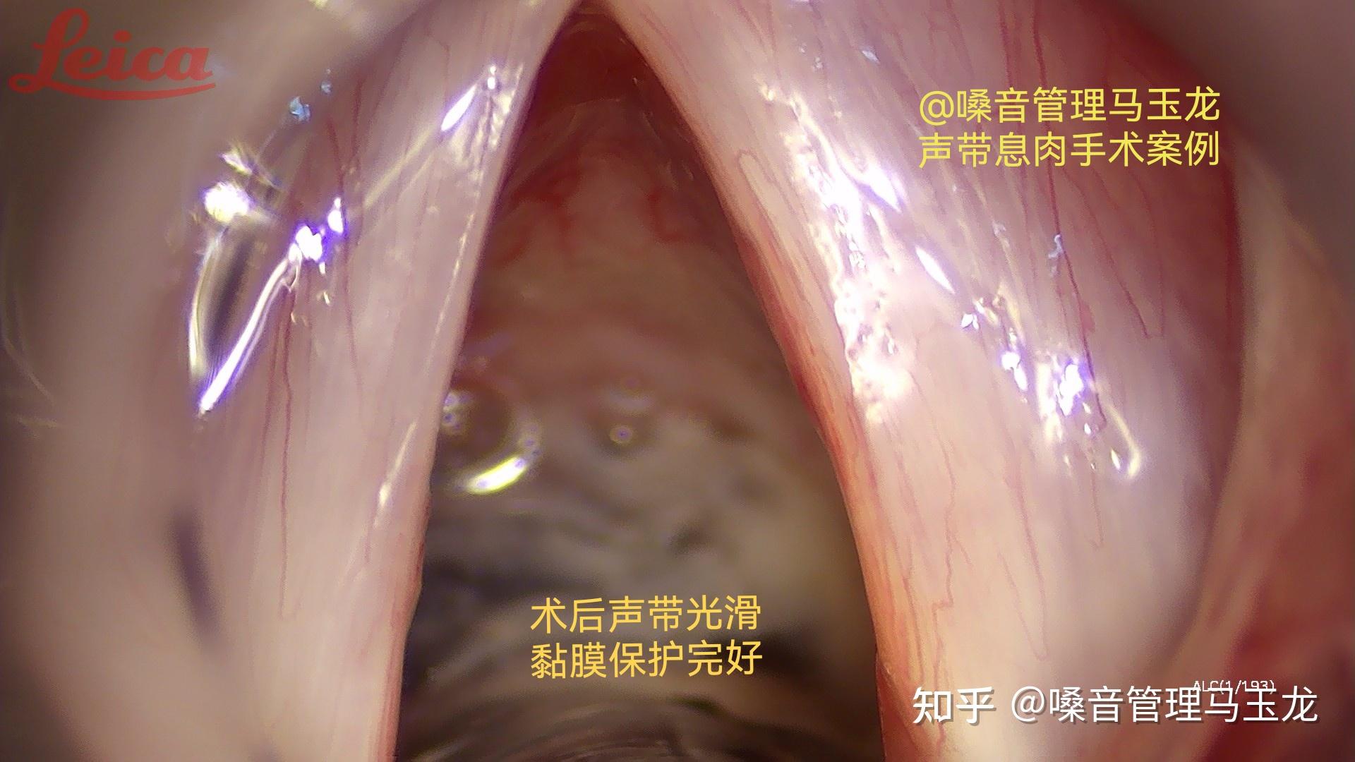 术前电子喉镜检查单侧声带息肉,手术中发现双侧声带息肉!