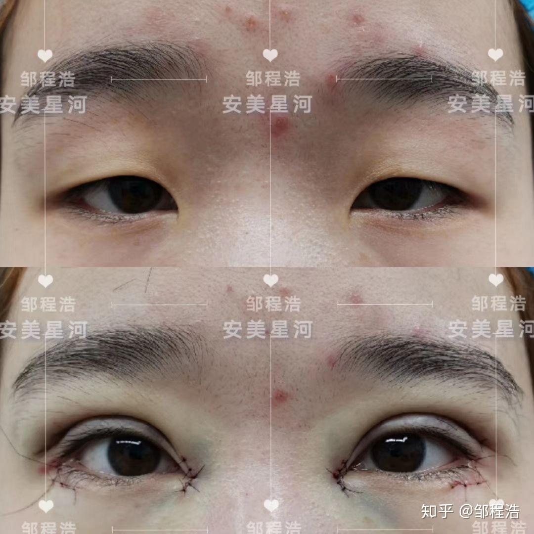 2019.6.13 双眼皮手术全过程+拆线及术后恢复-更新中 - 知乎