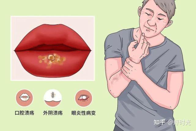 白塞病溃疡表现 - 知乎