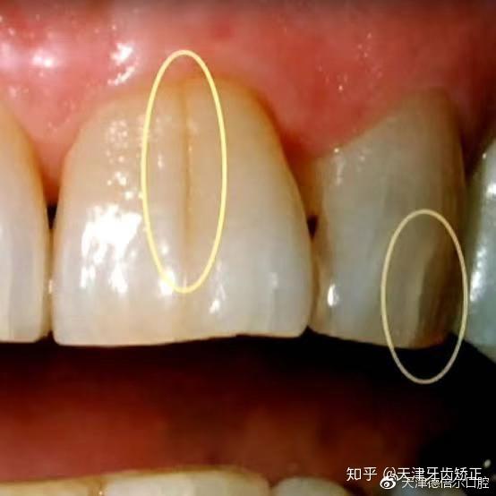 为什么一到秋冬季节一吸气就牙疼