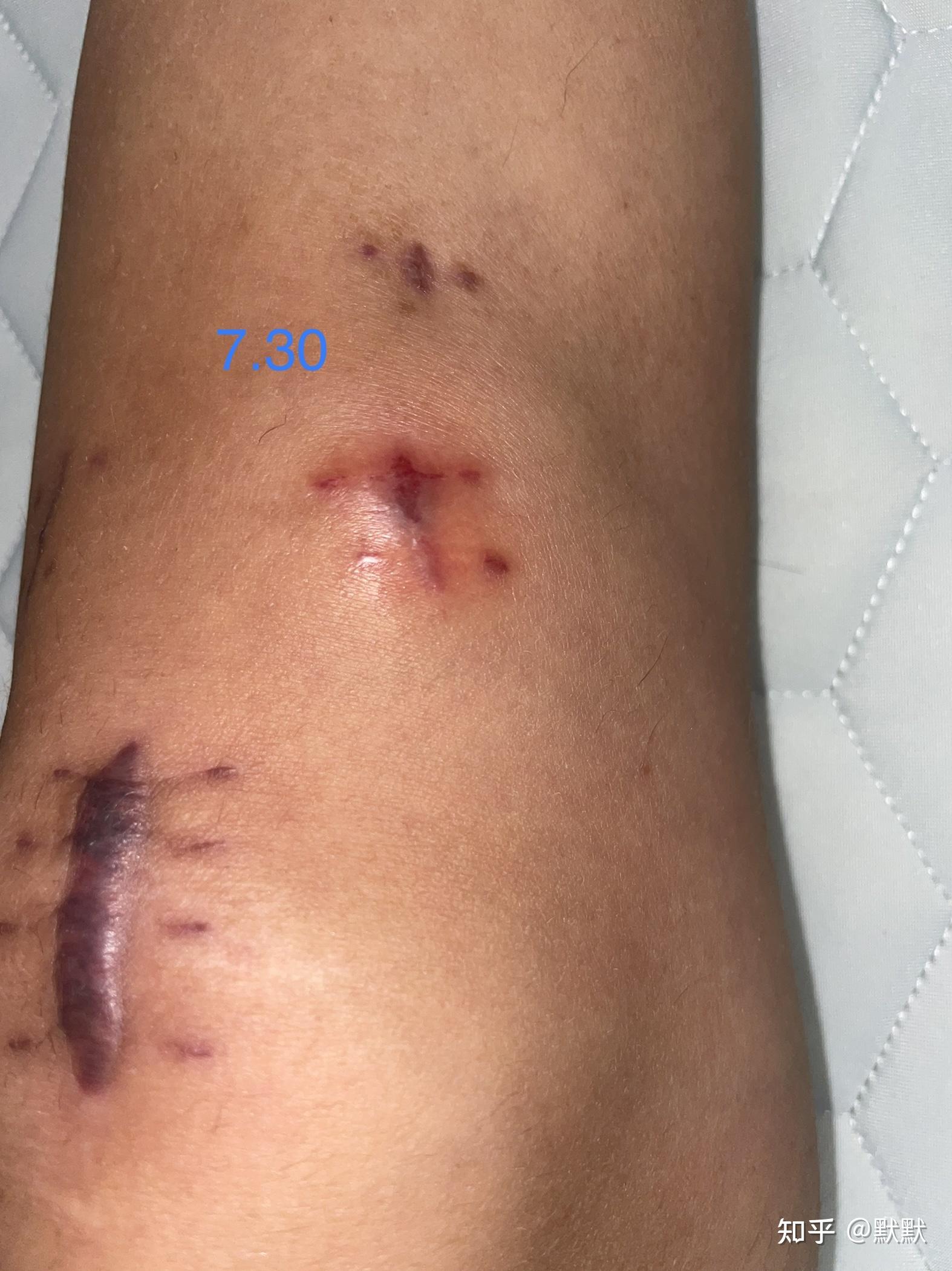 胫腓骨开放性骨折及踝骨裂 记录 - 知乎