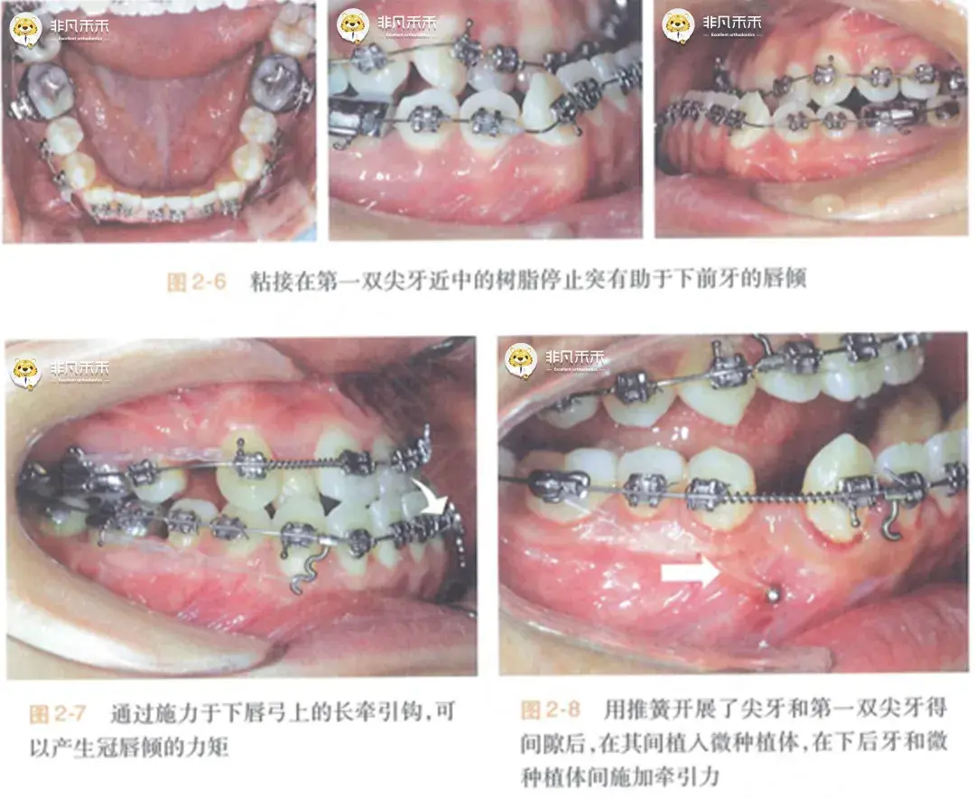 正畸科普骨性Ⅲ类患者术前的下颌牙齿去代偿