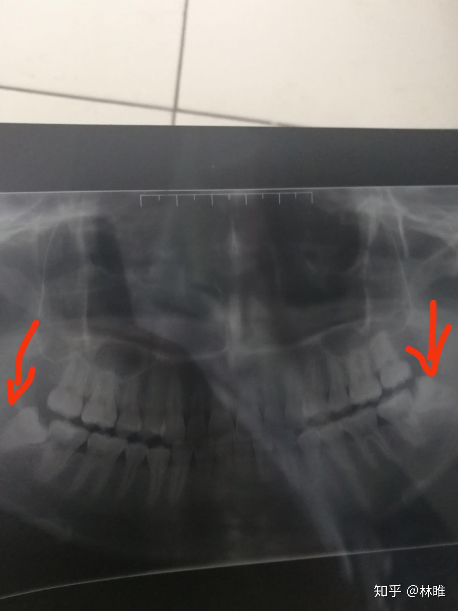 武大口腔医院拔智齿和洗牙价格如何?有何优势