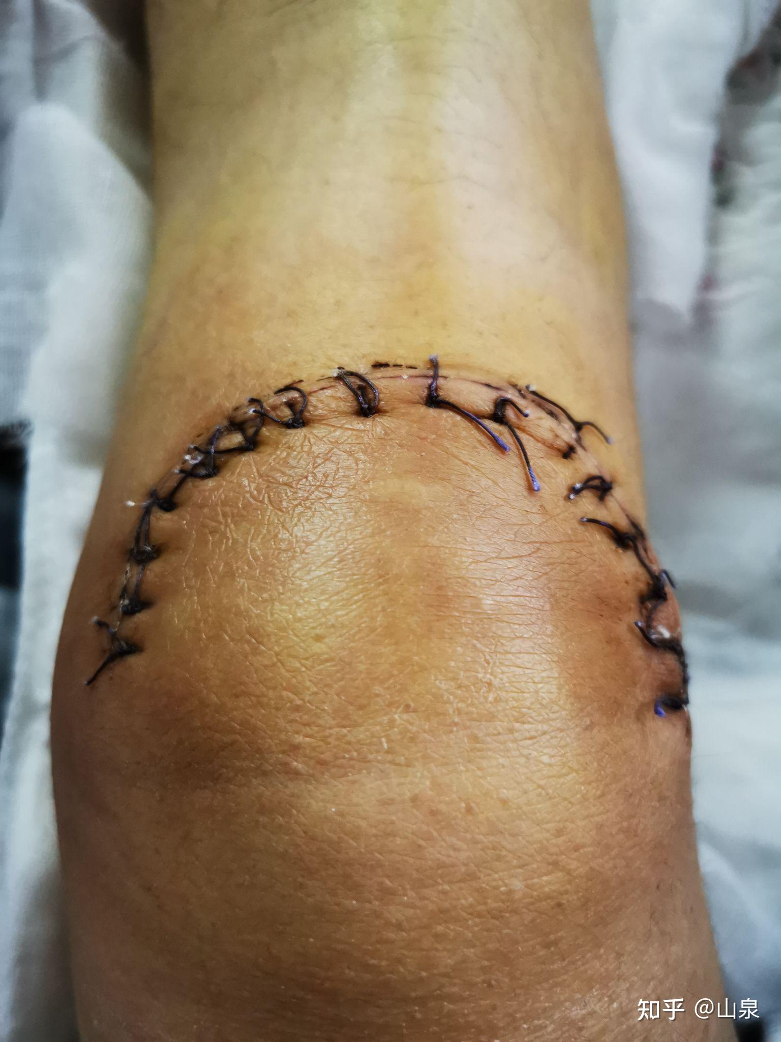 髌骨粉碎性骨折康复之路 - 知乎