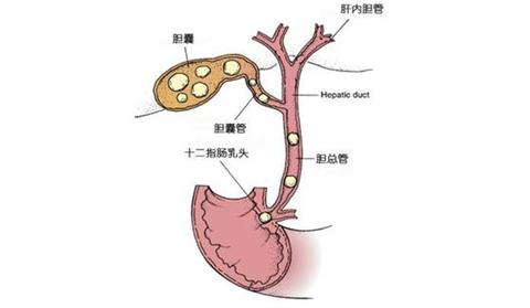 胆囊结石终结记实——省人医陆文熊团队超赞！(续三） - 知乎