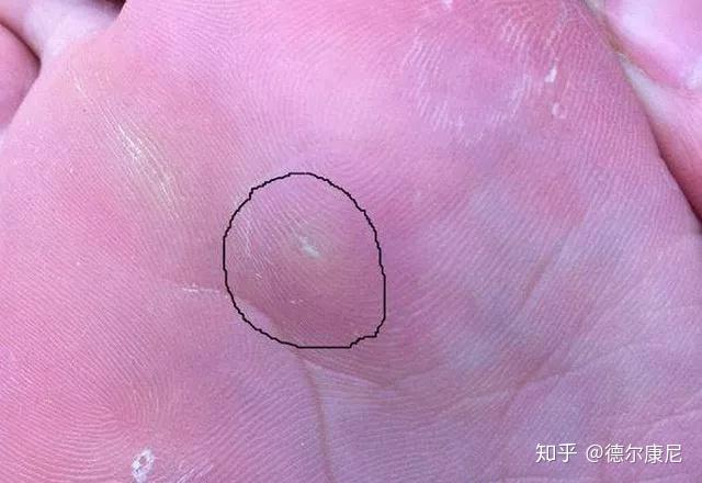 之所以称之为鸡眼,是因为这个病和鸡的眼睛确实非常像.