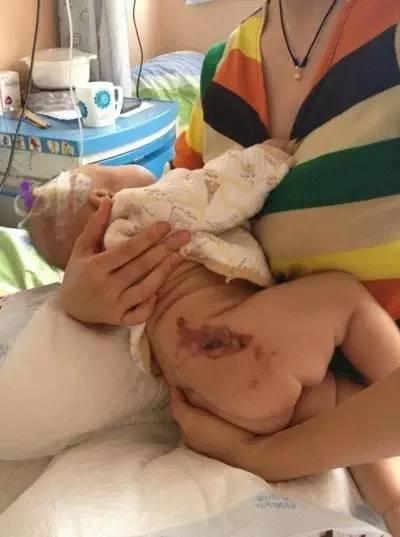 女婴烧伤图片