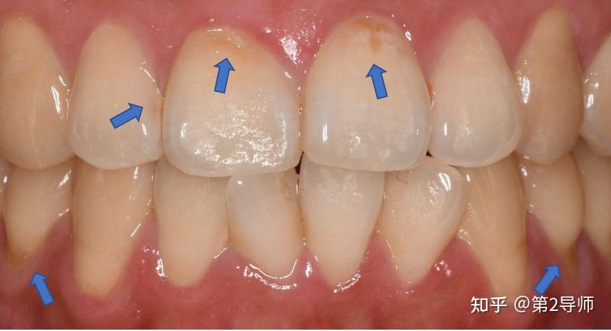 23岁小伙长期喝可乐致门牙腐坏脱落,碳酸饮料对牙齿危害有多大?