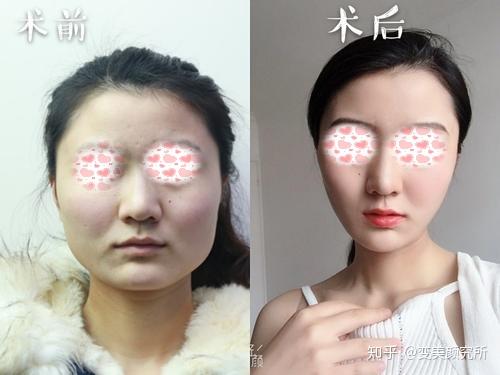 整容失败有多可怕?