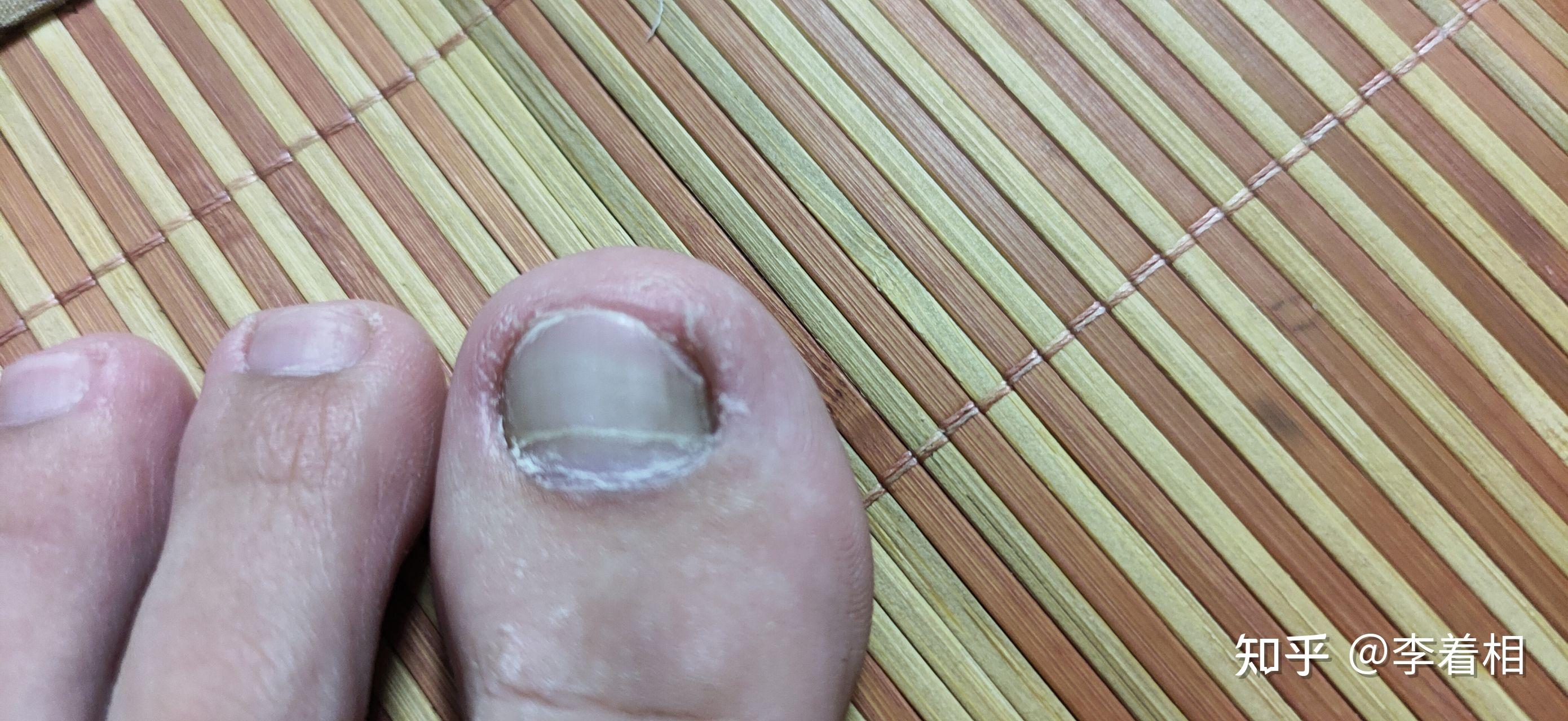 关注问题 67 写回答 登录/注册 指甲 脚趾甲 脚趾 大脚趾甲有一条