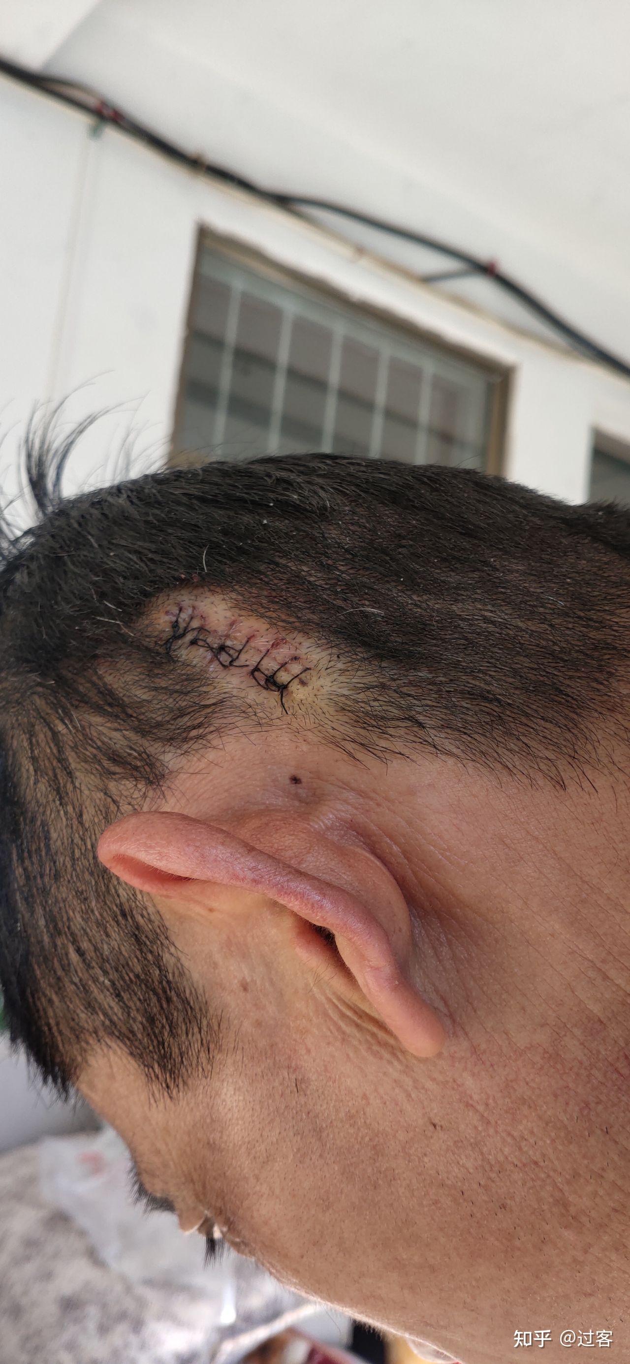 头皮粉瘤手术刀口图片图片