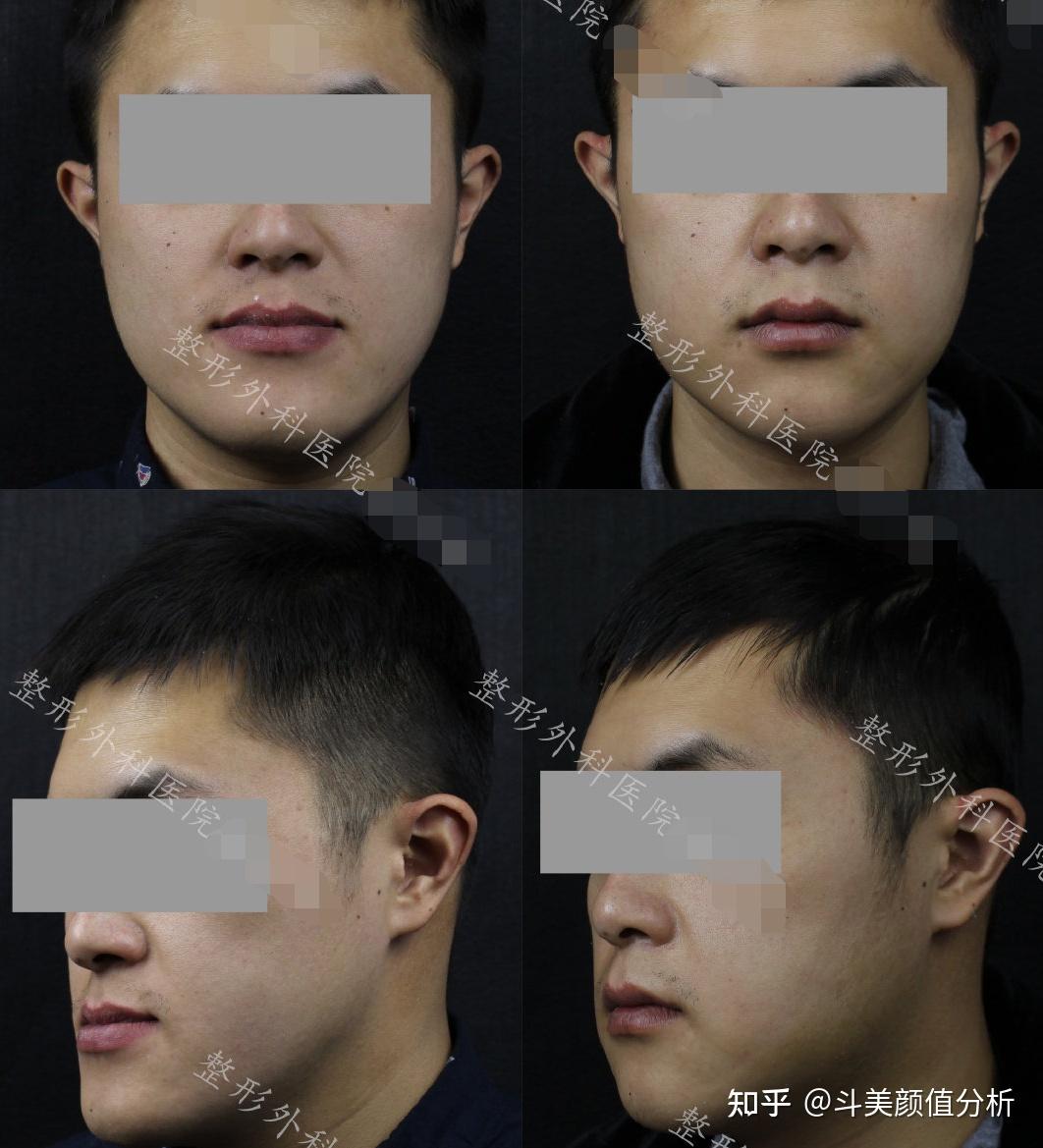 磨骨手术下颚有硬块_磨骨手术下颚角多少钱_下颚磨骨手术